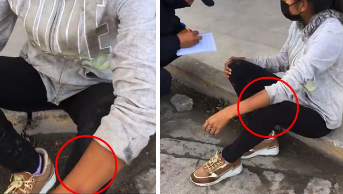 Perro pitbull atacó a una mujer cuando abría la cortina de un negocio y a un paramédico en Puebla