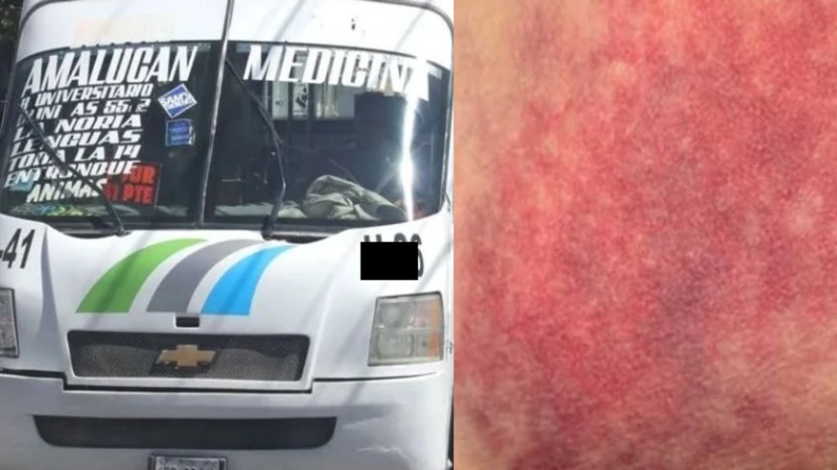 ¡Ruta 41 en la Mira! Conductor provoca accidente y deja lesionada a mujer en Puebla