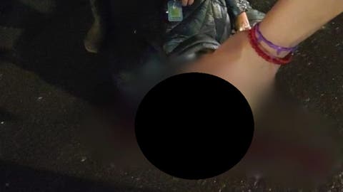 ¡Bache mortal! Poblana se desfigura el rostro tras accidente en scooter en Puebla