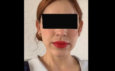 Mujer muere por lipo mal realizada en; doctora no tenía especialidad en cirugía plástica