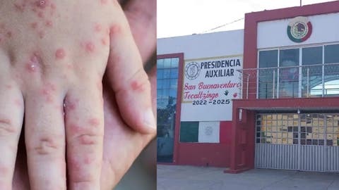 Brote de coxsackie en escuela de Puebla: confirman siete casos y activan cerco sanitario