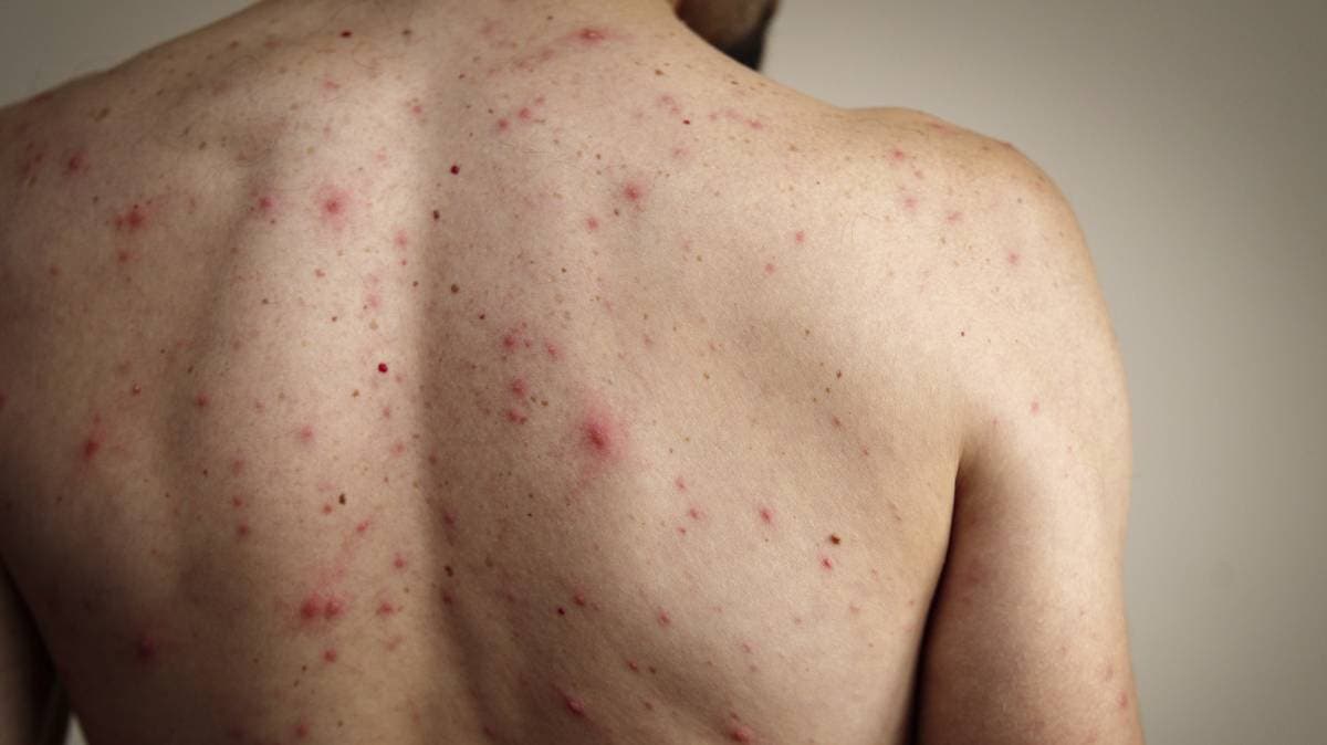 Sarampión mortal en Chihuahua: confirman primer fallecimiento y vinculan variante con brote en Texas