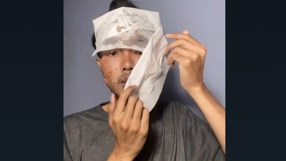 VIDEO Por no lavar ropa usada, joven contrae extraña enfermedad en la piel y se hace viral