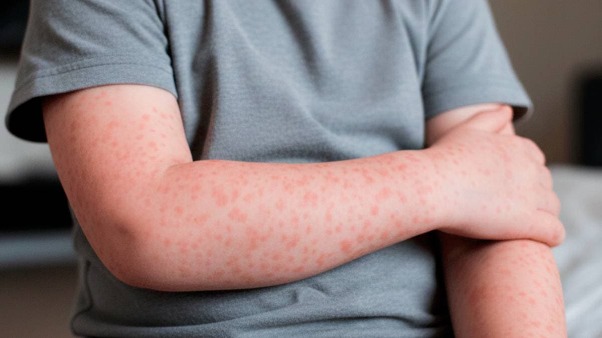Alerta sanitaria en Puebla: confirman cuatro casos de sarampión y activan cerco preventivo