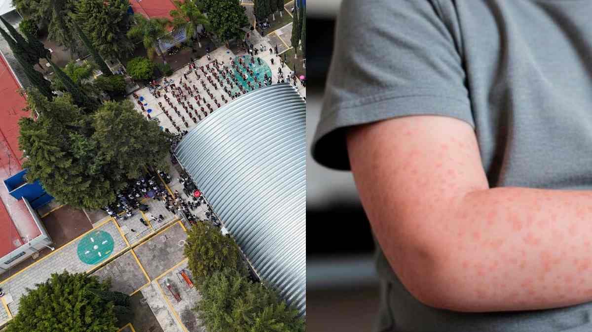 Alerta sanitaria en Puebla: Confirman caso de sarampión en secundaria del Centro Escolar Comunitario del Sur