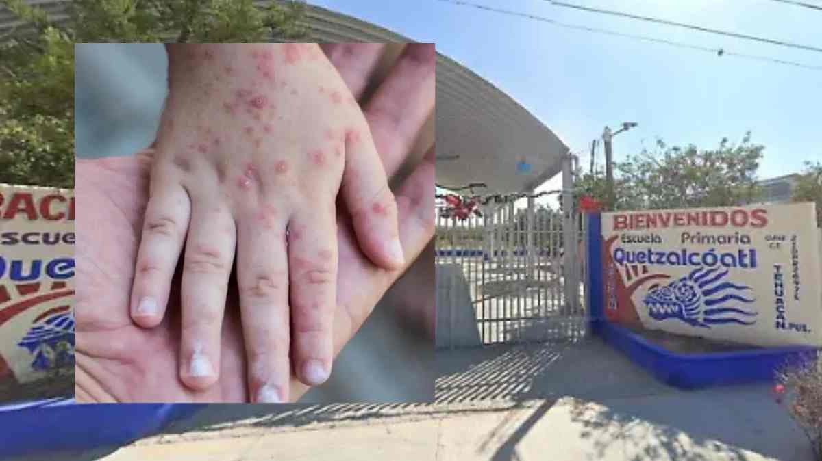 Brote de varicela activa alerta sanitaria en primaria de Tehuacán; confirman más de cinco casos activos