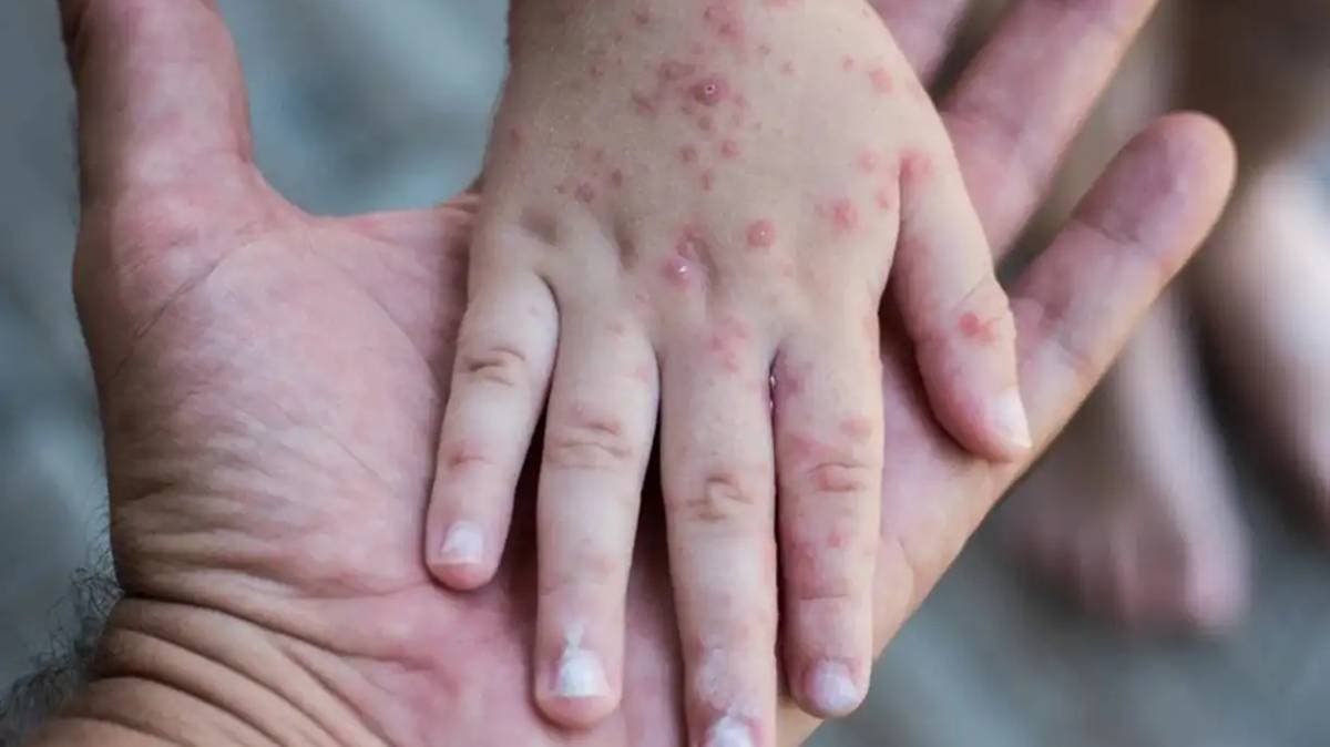 Alerta sanitaria en Tlaxcala: fallece un niño por complicaciones de sarampión