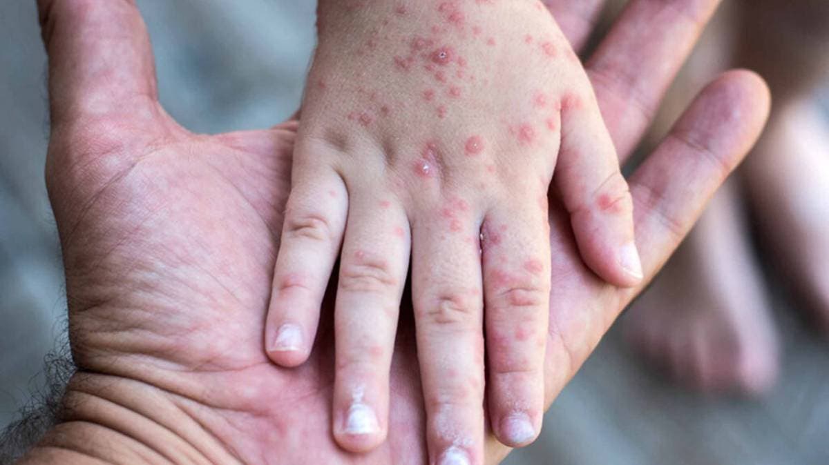 Puebla entra en lista prioritaria por sarampión; llaman a vacunarse a población de 13 a 49 años